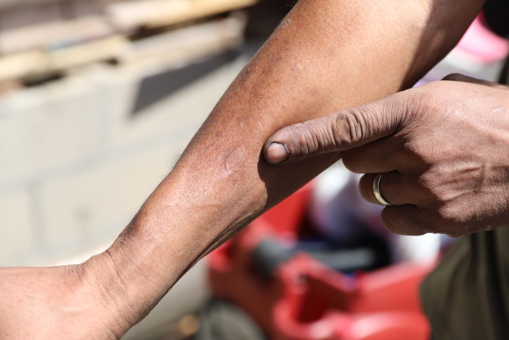 Edgardo Menjivar points to the scar on his arm left by an infection he said he received from working on his property after the flood. / Rami Alarian
